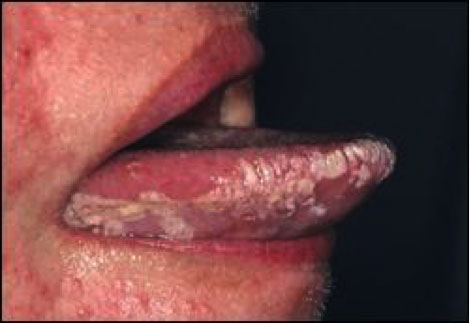 Les cancers de la bouche (cavité buccale) | Bücco