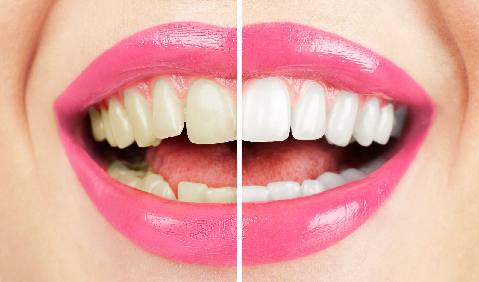 sourire blanchiment dentaire résultat avant/après