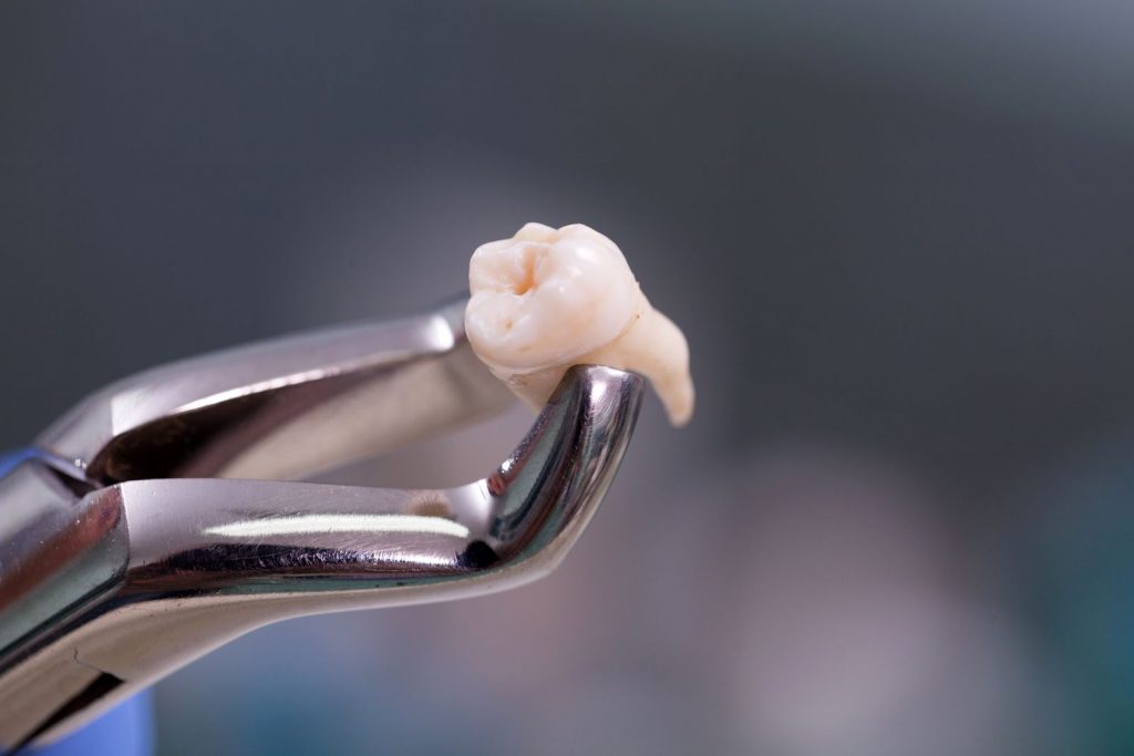 Que devez-vous savoir sur l’extraction dentaire ?