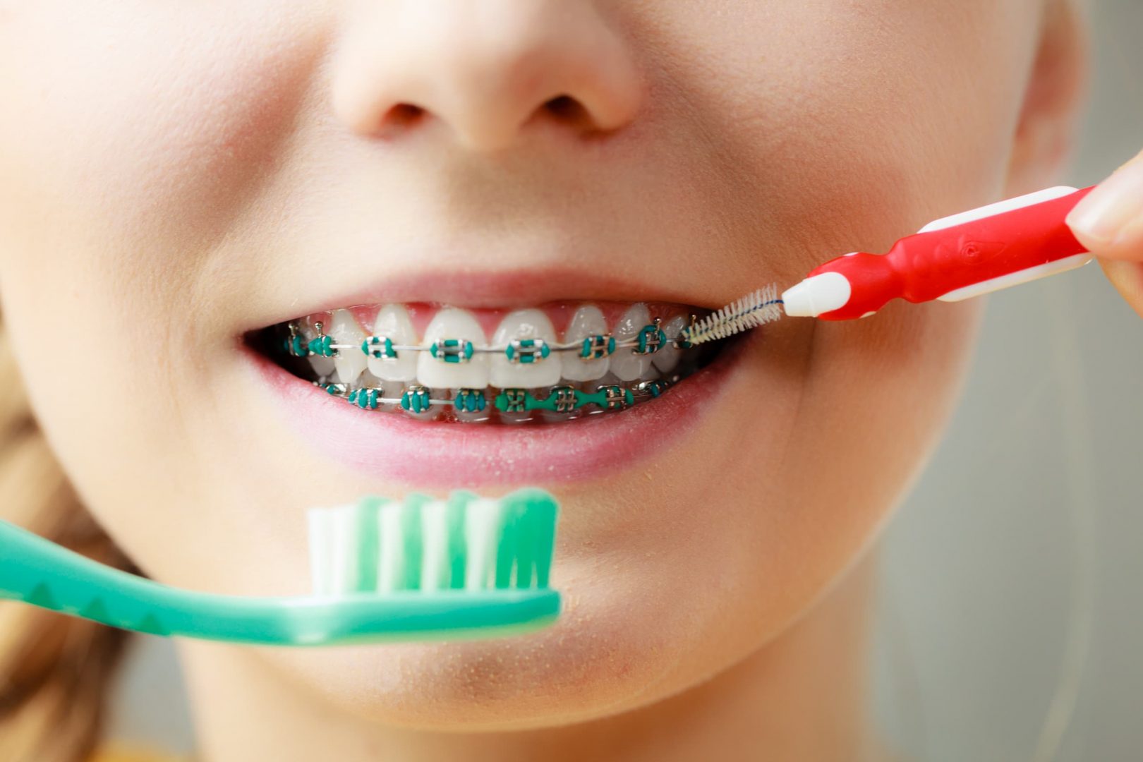 hygiène dentaire en orthodontie